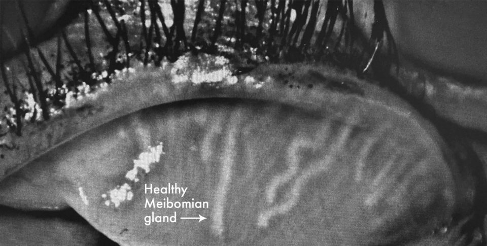 Ocular Surface Disease Treatment