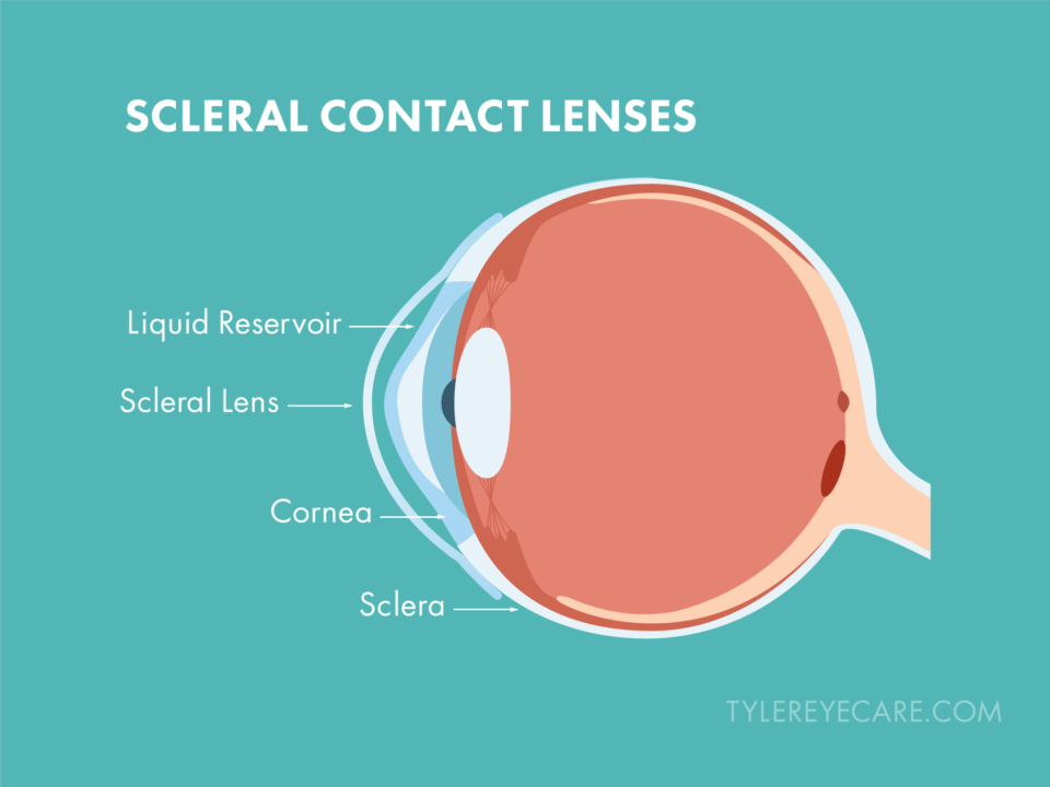 Scleral Contact Lenses